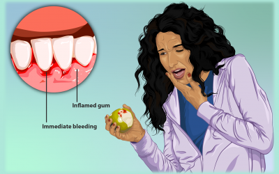 Gum Disease - Scaling and Root Planning