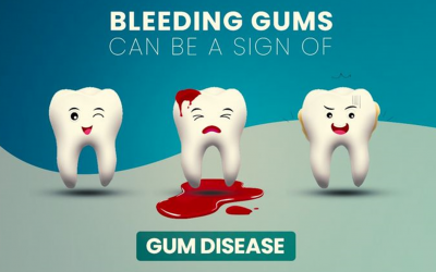 Are you facing a bleeding gums issue?